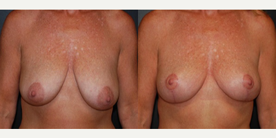 Case 8196 - Woman treated with Breast Reduction