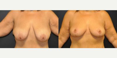 Case 8197 - 45-54 year old woman treated with Breast Reduction