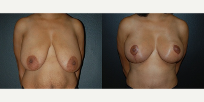 Case 8198 - Woman treated with Breast Reduction