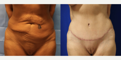 Case 82 - Woman treated with Tummy Tuck