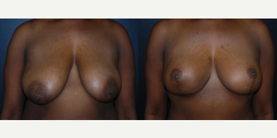 Case 8200 - Woman treated with Breast Reduction