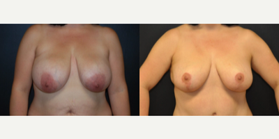 Case 8201 - Woman treated with Breast Reduction