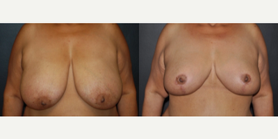 Case 8202 - Woman treated with Breast Reduction