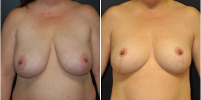 Case 8203 - 35-44 year old woman treated with Breast Reduction