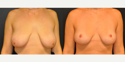 Case 8206 - 25-34 year old woman treated with Breast Reduction