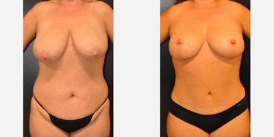 Case 8207 - 35-44 year old woman treated with Breast Reduction