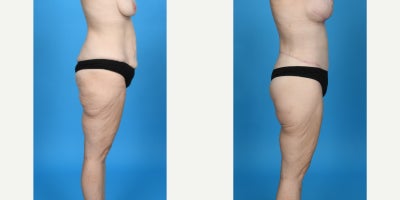 Case 821 - 35-44 year old woman treated with Abdominal Etching, Body Lift, Diastasis Recti Repair, Drainless Tummy Tuck, Liposculpture, Lip