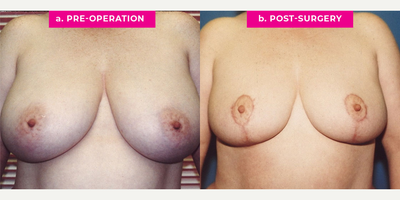 Case 8217 - 36 year old woman treated with Breast Reduction