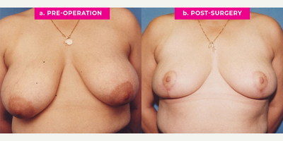 Case 8218 - 36 year old woman treated with Breast Reduction