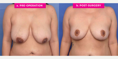 Case 8219 - 30 year old woman treated with Breast Reduction