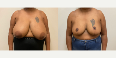 Case 8225 - Woman treated with Breast Reduction