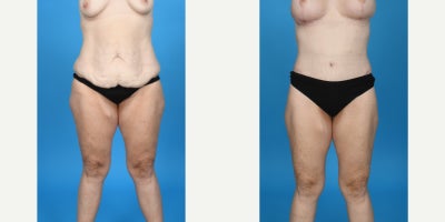 Case 824 - 35-44 year old woman treated with Abdominal Etching, Body Lift, Diastasis Recti Repair, Drainless Tummy Tuck, Liposculpture, Lip