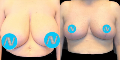 Case 8246 - Woman treated with Breast Reduction, Breast Lift