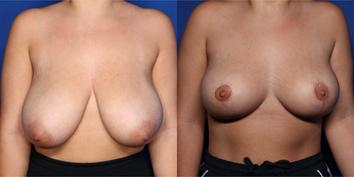 Case 8247 - 25-34 year old woman treated with Breast Reduction