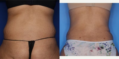 Case 825 - 45-54 year old femal treated with Tummy Tuck