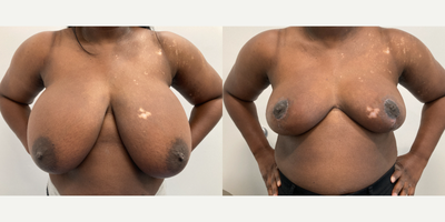 Case 8254 - 35-44 year old woman treated with Breast Reduction