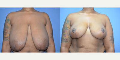 Case 8255 - 41 year old woman treated with Breast Reduction