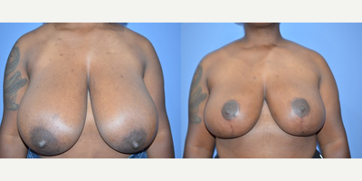 Case 8256 - 30 year old woman treated with Breast Reduction