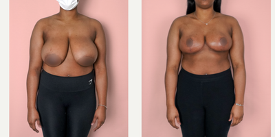 Case 8257 - 18-24 year old woman treated with Breast Reduction