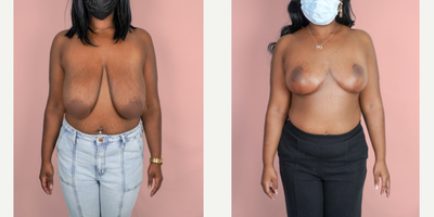 Case 8258 - 18-24 year old woman treated with Breast Reduction