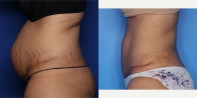 Case 826 - 45-54 year old femal treated with Tummy Tuck