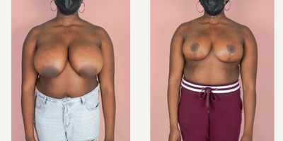 Case 8260 - 25-34 year old woman treated with Breast Reduction