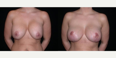 Case 8265 - Woman treated with Breast Reduction