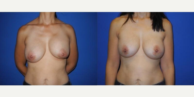 Case 8266 - Woman treated with Breast Reduction