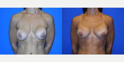 Case 8267 - Woman treated with Breast Reduction