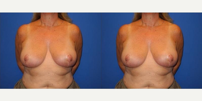 Case 8268 - Woman treated with Breast Reduction