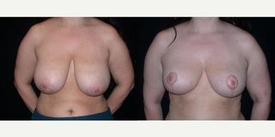 Case 8269 - Woman treated with Breast Reduction