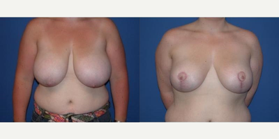 Case 8270 - Woman treated with Breast Reduction