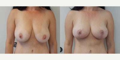 Case: 8272 - before and after photo of Woman treated with Breast Lift by Richard H. Lee, MD