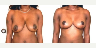 Case: 8274 - before and after photo of Woman treated with Breast Lift by Richard H. Lee, MD