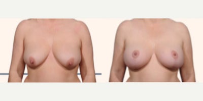 Case: 8277 - before and after photo of Woman treated with Breast Lift by John L. Burns Jr., MD
