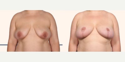 Case: 8278 - before and after photo of Woman treated with Breast Lift by John L. Burns Jr., MD