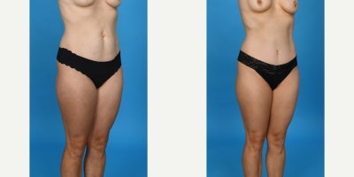 Case 828 - 35-44 year old woman treated with Abdominal Etching, Diastasis Recti Repair, Drainless Tummy Tuck, Liposculpture, Liposuction, M