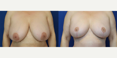 Case 8283 - Woman treated with Breast Lift