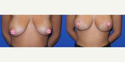 Case 8285 - Woman treated with Breast Lift