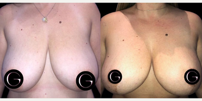Case 8286 - Woman treated with Breast Lift