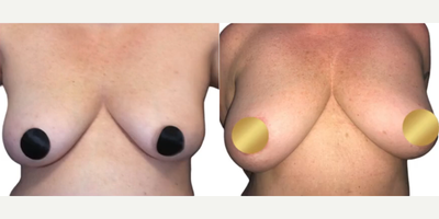 Case 8287 - Woman treated with Breast Lift, Breast Fat Transfer