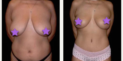 Case 8294 - Woman treated with Breast Lift