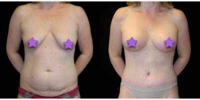 Case 8295 - Woman treated with Breast Lift