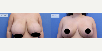 Case 8296 - Woman treated with Breast Lift