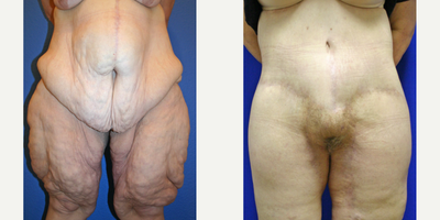 Case 83 - 45-54 year old woman treated with Tummy Tuck