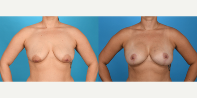 Case 8304 - 35-44 year old woman treated with Breast Lift, Breast Fat Transfer