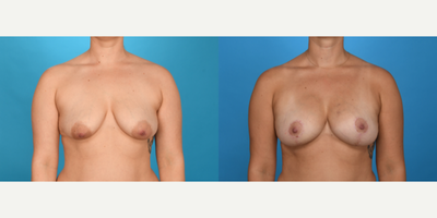 Case 8305 - 35-44 year old woman treated with Breast Lift, Breast Fat Transfer