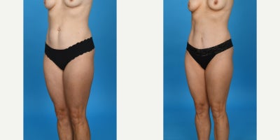 Case 831 - 35-44 year old woman treated with Abdominal Etching, Diastasis Recti Repair, Drainless Tummy Tuck, Liposculpture, Liposuction, M