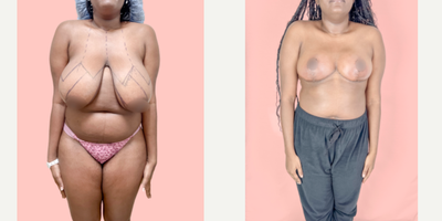 Case 8310 - 18-24 year old woman treated with Breast Reduction, Breast Lift