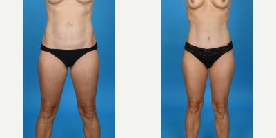 Case 832 - 35-44 year old woman treated with Abdominal Etching, Diastasis Recti Repair, Drainless Tummy Tuck, Liposculpture, Liposuction, M